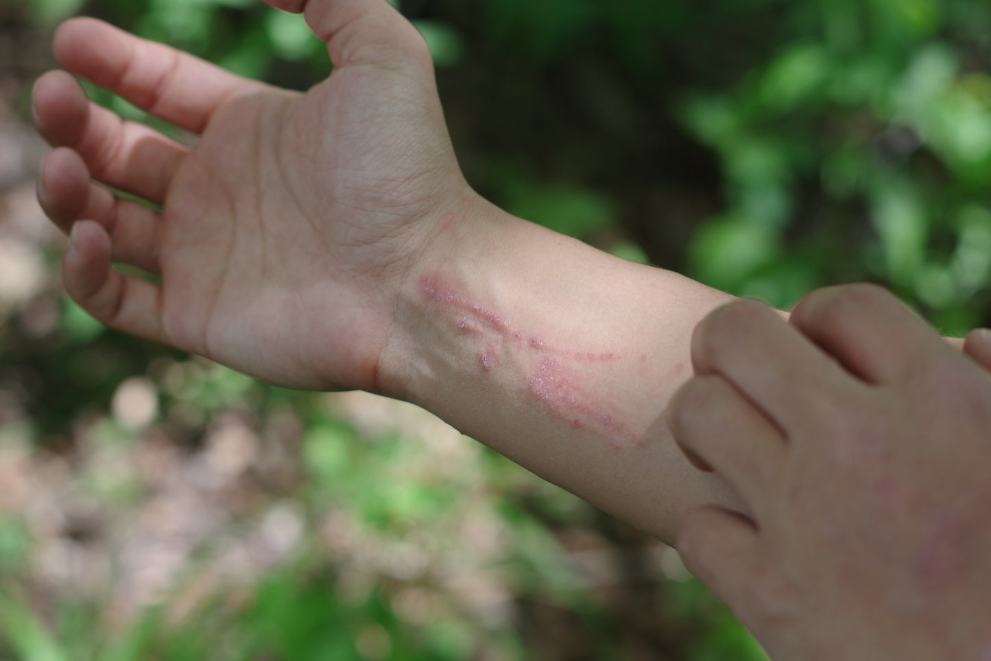 Poison Ivy Relief